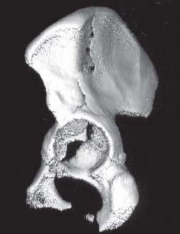 3 Bacia, Anca e Coxa Figura 3.21 TAC do acetábulo mostrando fractura da cabeça femoral associada a fractura acetabular. A fractura da cabeça femoral não era visível no Rx. Figura 3.22 TAC tridimensional de fractura da coluna anterior com posterior hemitransversa.