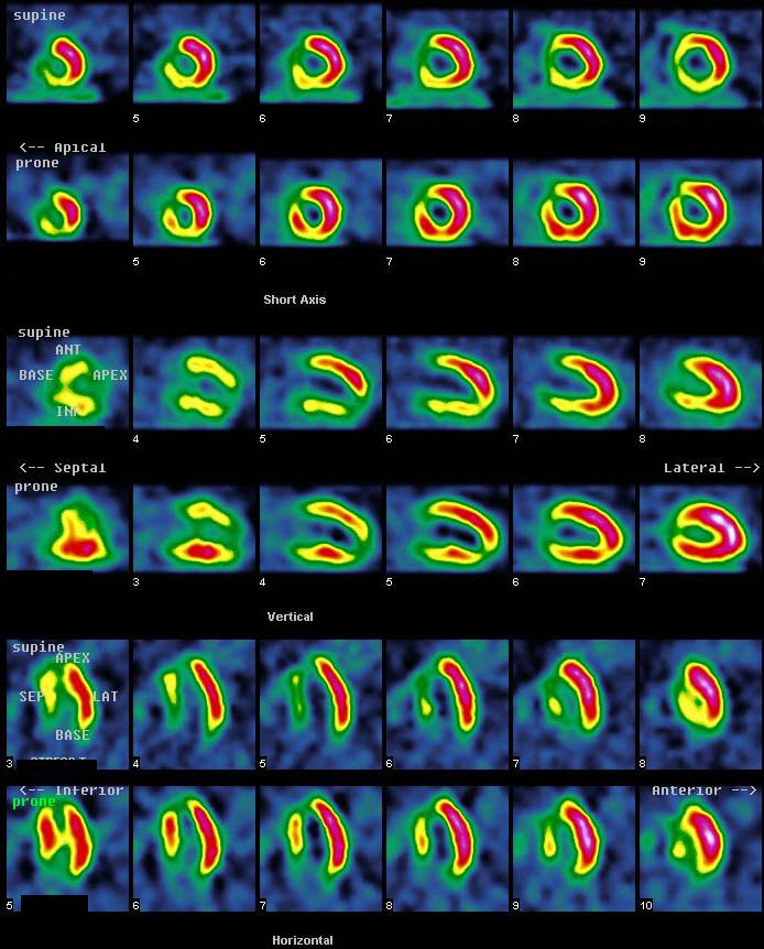 A 37 year-old male presenting to the ED with typical chest pain. He was administered 25 mci 99m Tc-tetrofosmin IV and SPECT images were obtained in the supine and prone position.