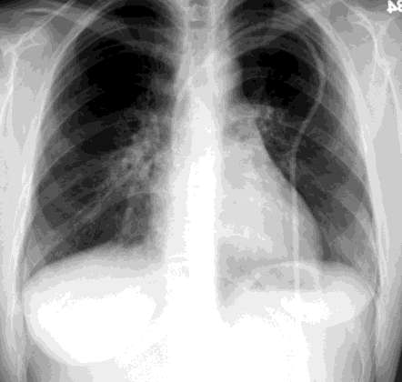 Pneumonias Avaliar e tratar etiologia suspeita Infiltrado nodular obscurecendo a borda cardíaca direita é uma