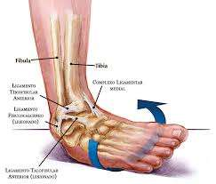 Uma entorse por inversão do tornozelo pode ocorrer devido a alguma irregularidade do solo ou simplesmente por um apoio mal efetuado do pé.