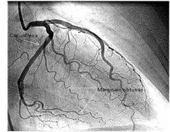 Angiografia de contraste Deve ser efectuado com cautela uma vez que muitos diabéticos apresentam nefropatia.