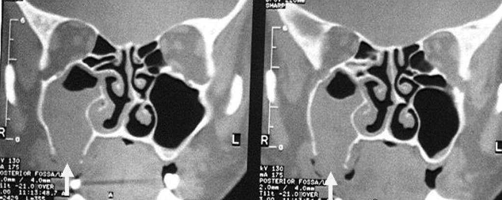 INTRODUÇÃO As fístulas do assoalho do seio maxilar podem ser de 3 tipos: oronasal, oroantral e oroantronasal 1.
