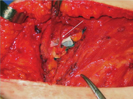 Escolha do vaso receptor em reconstrução de mama microcirúrgica Figura 1 Dissecção dos vasos mamários internos. Ressecção da cartilagem costal para dissecção dos vasos mamários internos.