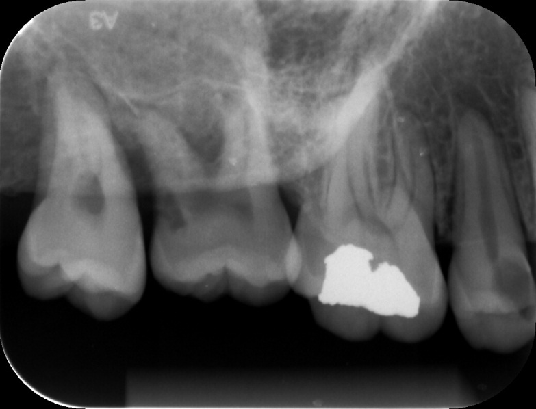 49 Figura 6: Radiografia peripical digital. Espécime pertencente ao grupo RCI2 posicionado no alvéolo do dente 17 ausente. 4.6.2 Tomografia Computadorizada de Feixe Cônico As imagens tomográficas foram adquiridas no aparelho i-cat, com 120kV e 3-8mA (Imaging Sciences Internacional EUA).