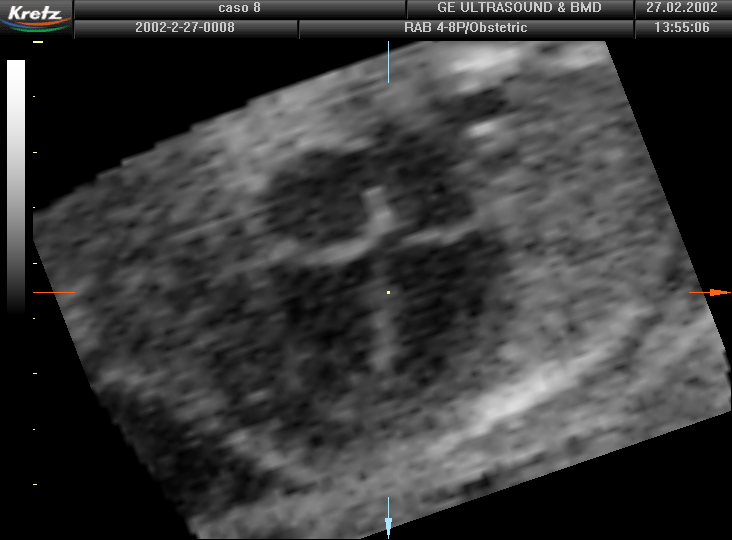 5- Scharf A, Geka F, Steinborn A, Frey H, Schlemmer A, Sohn C: 3D real-time imaging of fetal heart. Fetal Diagn Ther 2000 Sep-Oct;15(5): 267-74.