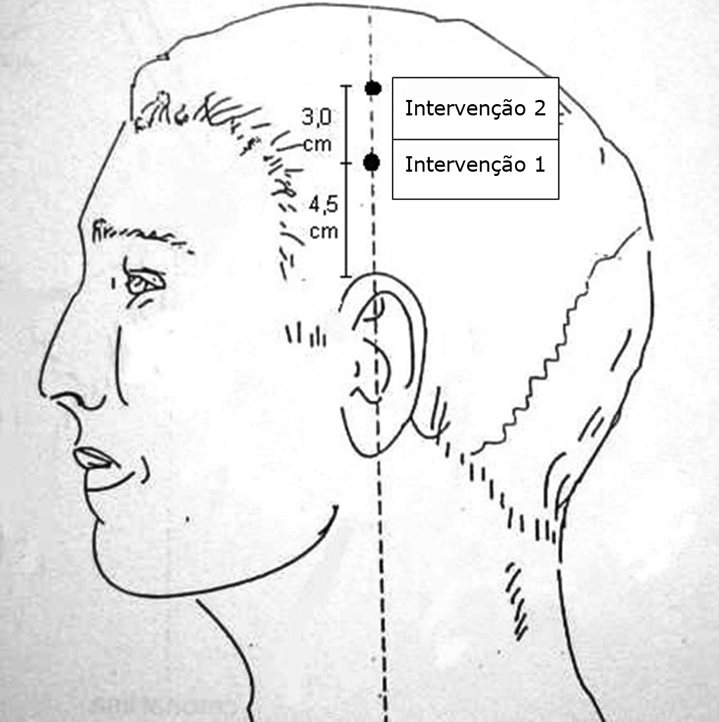 supressão menos efetiva quando comparados a indivíduos sem queixa de zumbido.