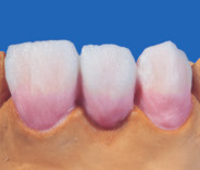 VMK95_905_POR 02.12.2005 14:28 Uhr Seite 10 4. Estratificação da dentina numa ponte A estratificação do esmalte e da dentina realiza-se de forma análoga ao de coroas individuais.