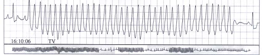 73 Figura 5 - Traçado eletrocardiográfico obtido durante monitorização Holter de animal com CMD, demontrando fibrilação atrial Figura 6