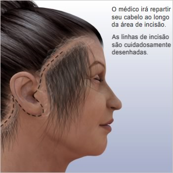 Como funciona o lifting facial do terço inferior? Existem vários tipos de lifting facial, sendo que cada um corrige uma determinada área da face.