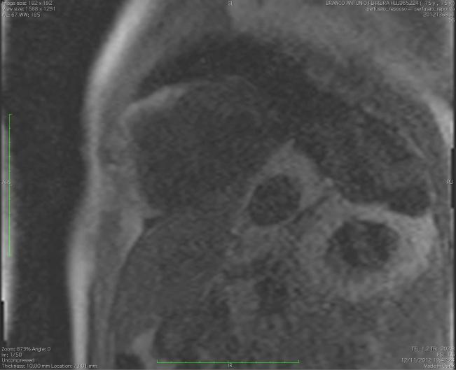 Função endotelial e Microcirculação no EAM Caso 2 Ressonância Magnética Cardíaca Área de Necrose
