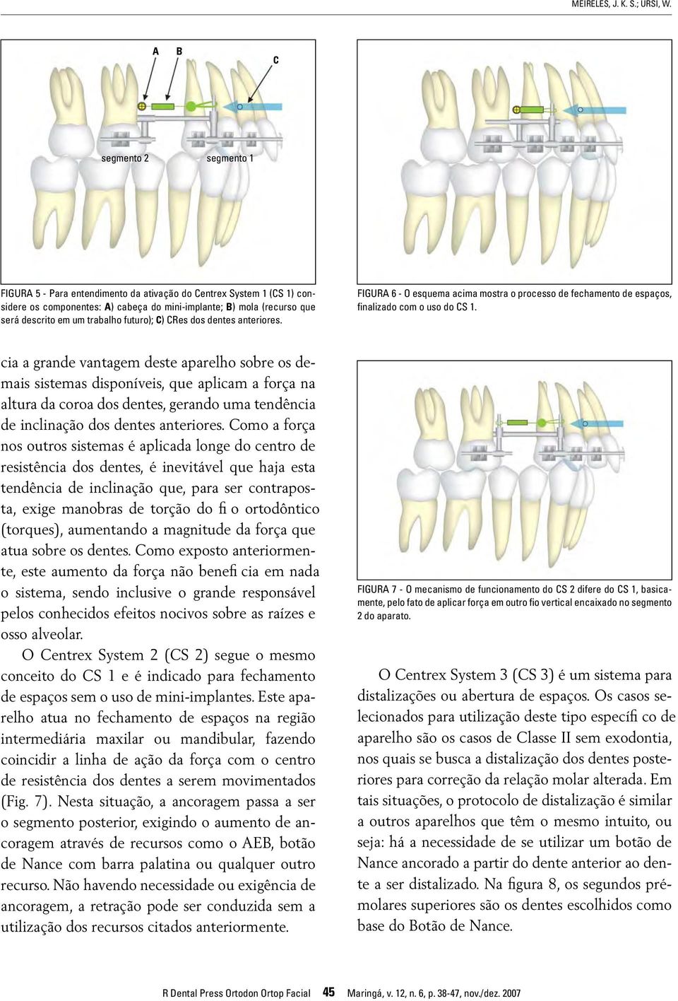 futuro); C) CRes dos dentes anteriores. FIGURA 6 - O esquema acima mostra o processo de fechamento de espaços, finalizado com o uso do CS 1.