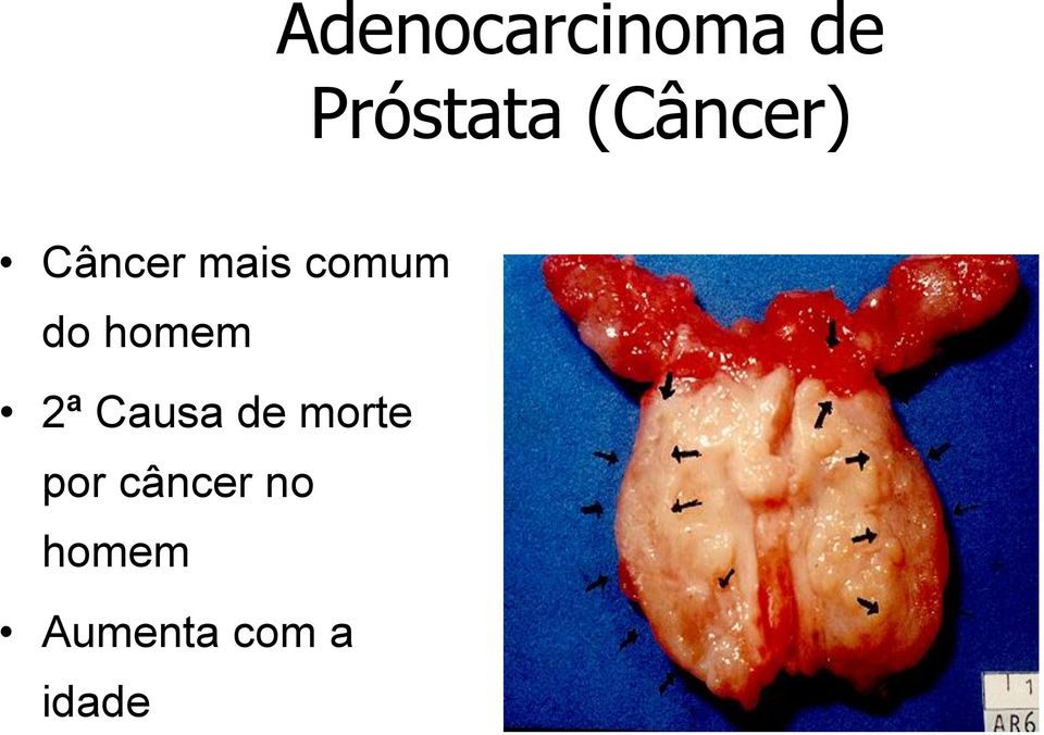 homem 2ª Causa de morte por