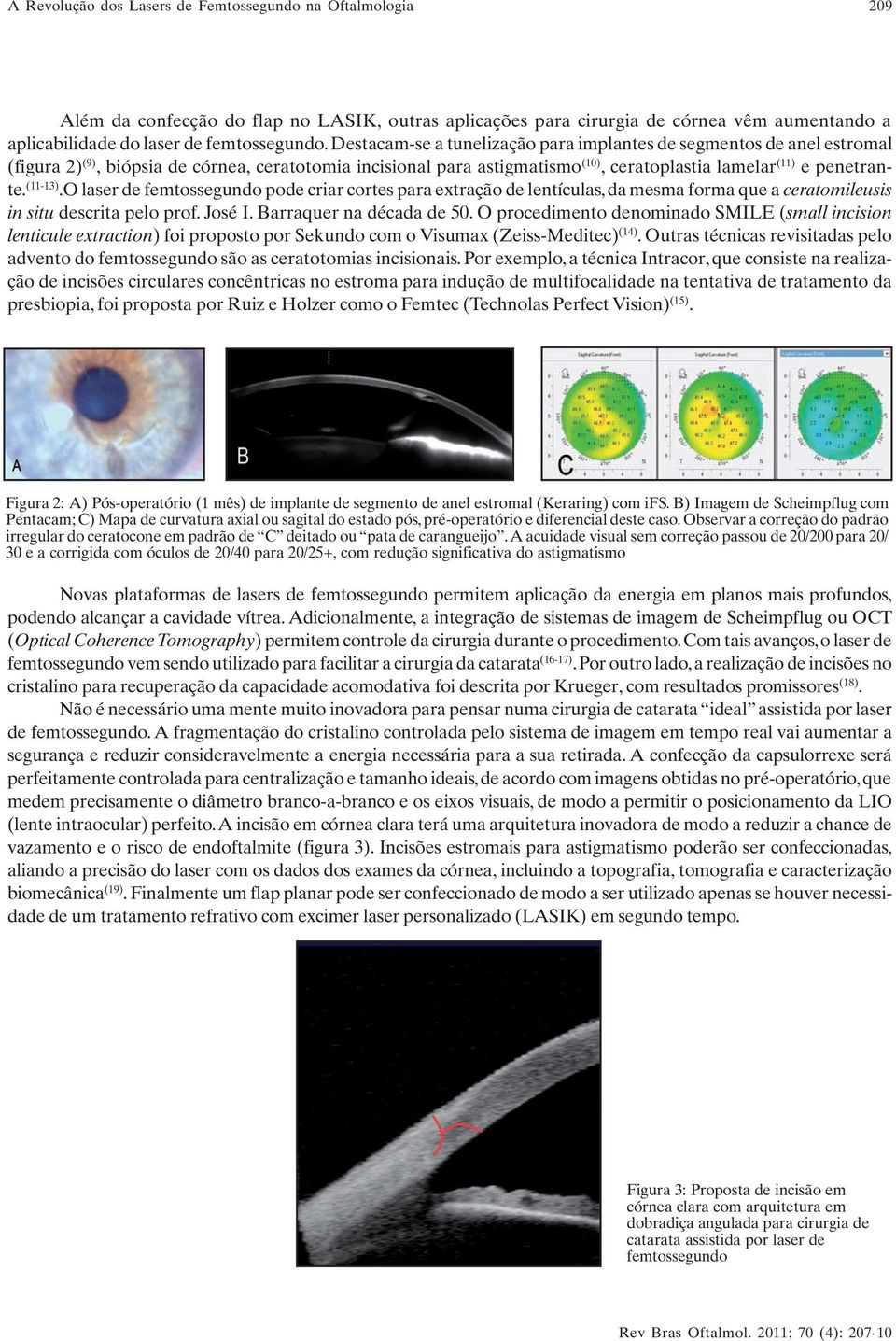 (11-13).O laser de femtossegundo pode criar cortes para extração de lentículas, da mesma forma que a ceratomileusis in situ descrita pelo prof. José I. Barraquer na década de 50.