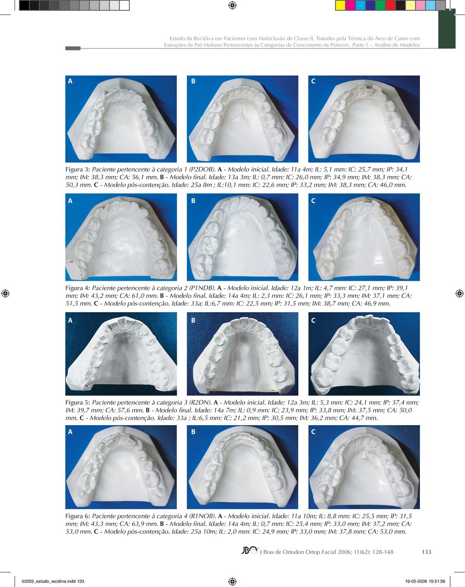 B - Modelo final. Idade: 13a 3m; IL: 0,7 mm: IC: 26,0 mm; IP: 34,9 mm; IM: 38,3 mm; CA: 50,3 mm. C - Modelo pós-contenção.