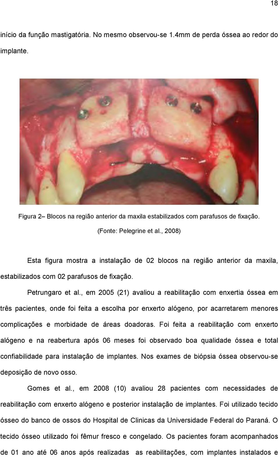 , em 2005 (21) avaliou a reabilitação com enxertia óssea em três pacientes, onde foi feita a escolha por enxerto alógeno, por acarretarem menores complicações e morbidade de áreas doadoras.