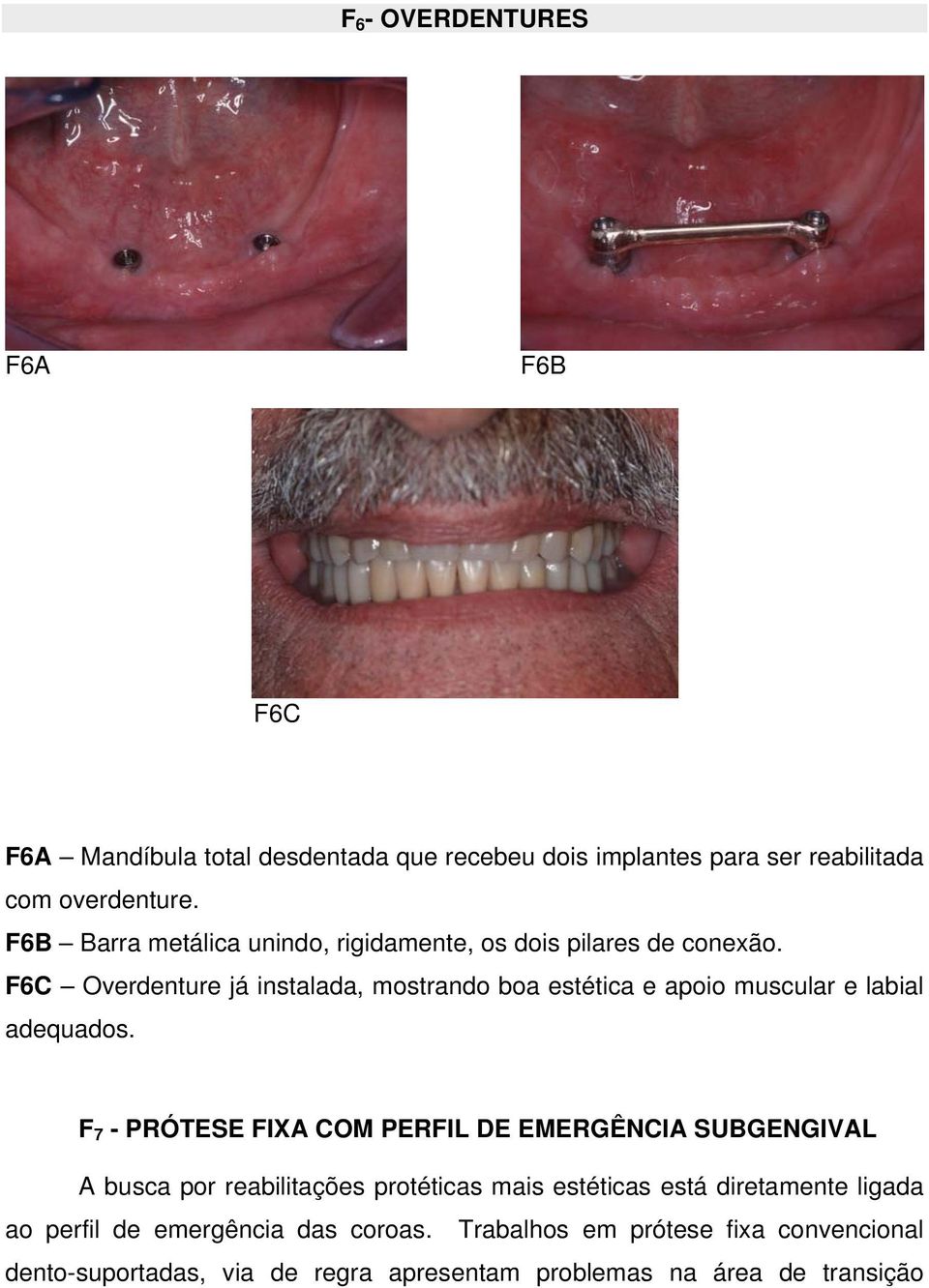 F6C Overdenture já instalada, mostrando boa estética e apoio muscular e labial adequados.