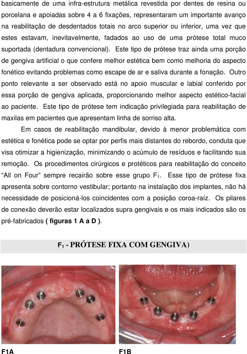 Este tipo de prótese traz ainda uma porção de gengiva artificial o que confere melhor estética bem como melhoria do aspecto fonético evitando problemas como escape de ar e saliva durante a fonação.