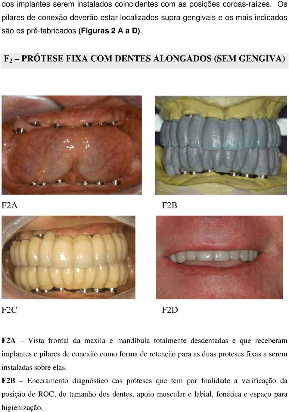 F 2 PRÓTESE FIXA COM DENTES ALONGADOS (SEM GENGIVA) F2A F2B F2C F2D F2A Vista frontal da maxila e mandíbula totalmente desdentadas e que receberam implantes e