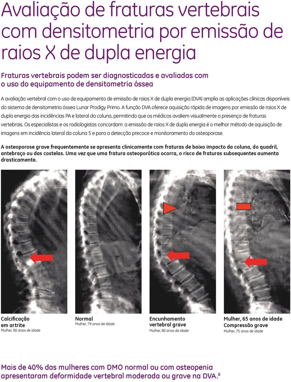 A função DVA oferece aquisição rápida de imagens por emissão de raios X de dupla energia das incidências PA e lateral da coluna, permitindo que os médicos avaliem visualmente a presença de fraturas