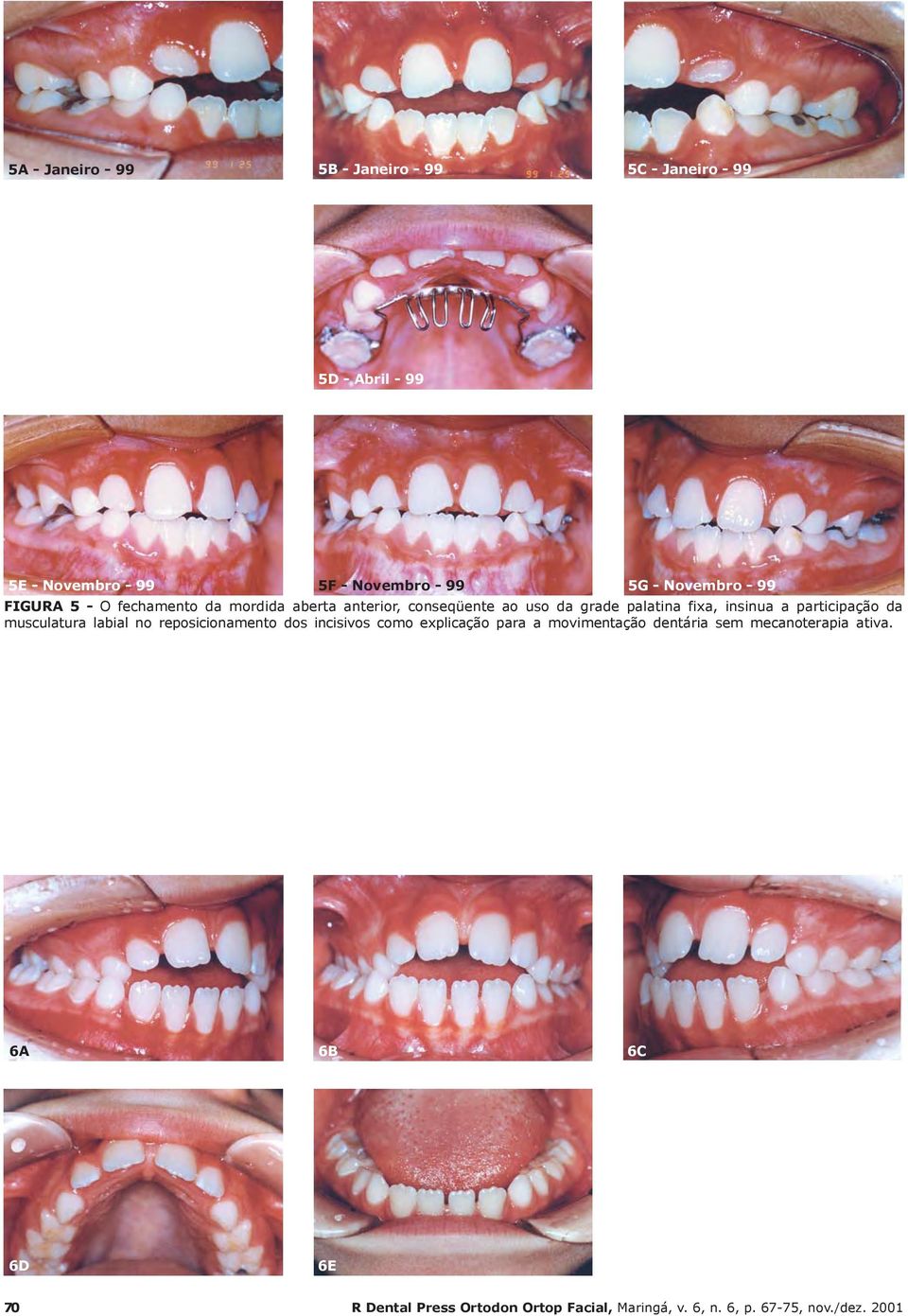 a participação da musculatura labial no reposicionamento dos incisivos como explicação para a movimentação dentária