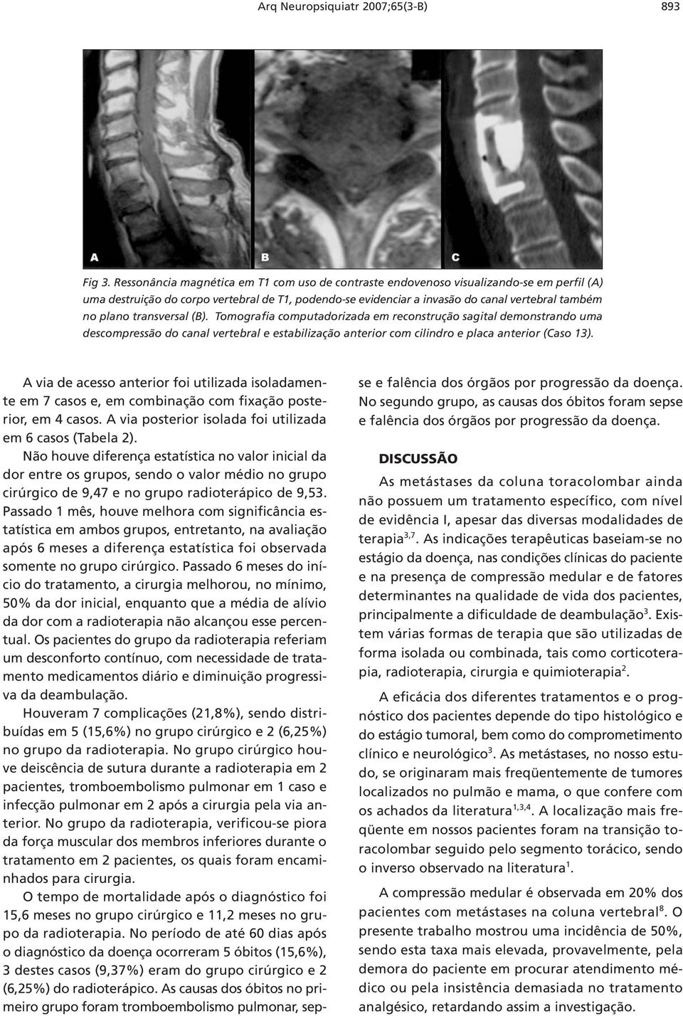 transversal (B). Tomografia computadorizada em reconstrução sagital demonstrando uma descompressão do canal vertebral e estabilização anterior com cilindro e placa anterior (Caso 13).