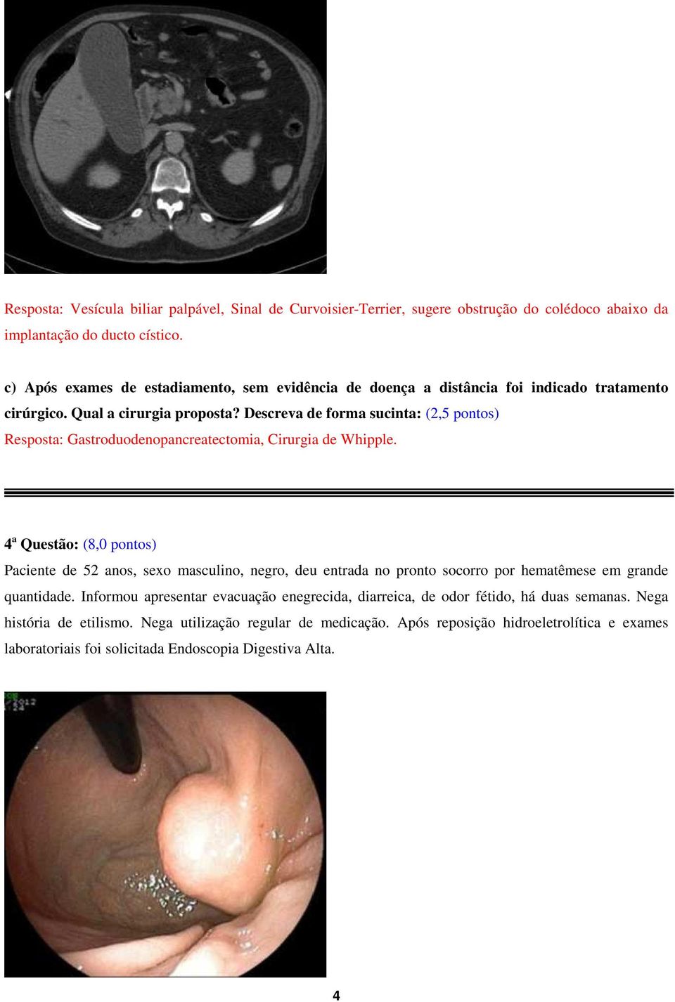 Descreva de forma sucinta: (2,5 pontos) Resposta: Gastroduodenopancreatectomia, Cirurgia de Whipple.