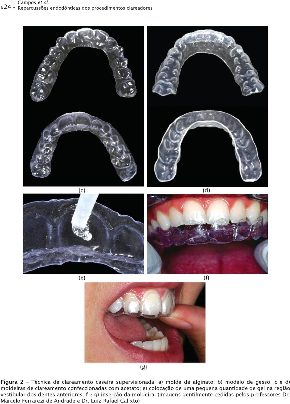 molde de alginato; b) modelo de gesso; c e d) moldeiras de clareamento confeccionadas com acetato; e) colocação de