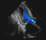 Efeito Doppler Fluxo e velocidade f = 2 f c