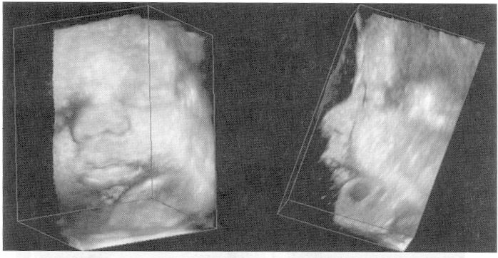 The 3D image of the fetal face has been rendered using a translucencyrendering algorithm with the ray-casting approach.