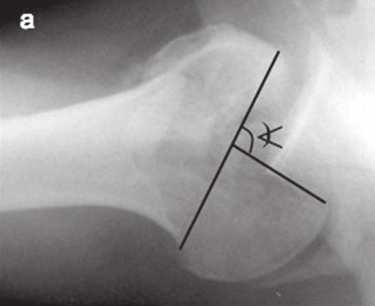 Tratamento não artroplástico da luxação posterior permanente do ombro associada a grande defeito ósseo 577 b < <) ) -x % 180 0-100 % Figura 1 a) Radiografia do ombro em perfil axilar mostrando o