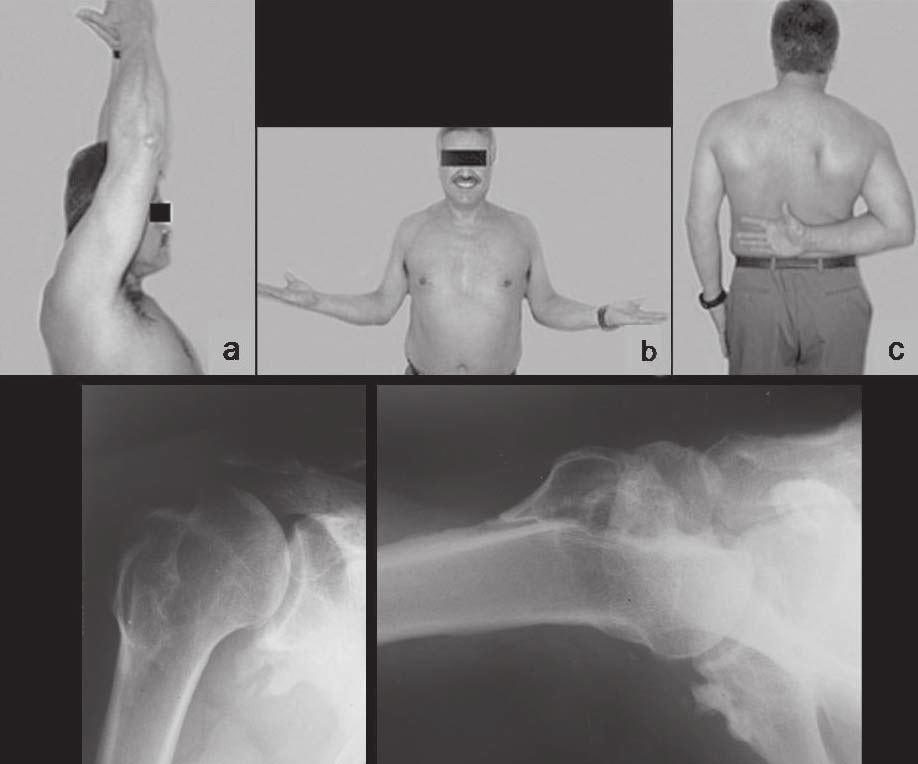 Tratamento não artroplástico da luxação posterior permanente do ombro associada a grande defeito ósseo 579 A manobra de Gerber (25) foi negativa em todos os ombros que evoluíram com resultados