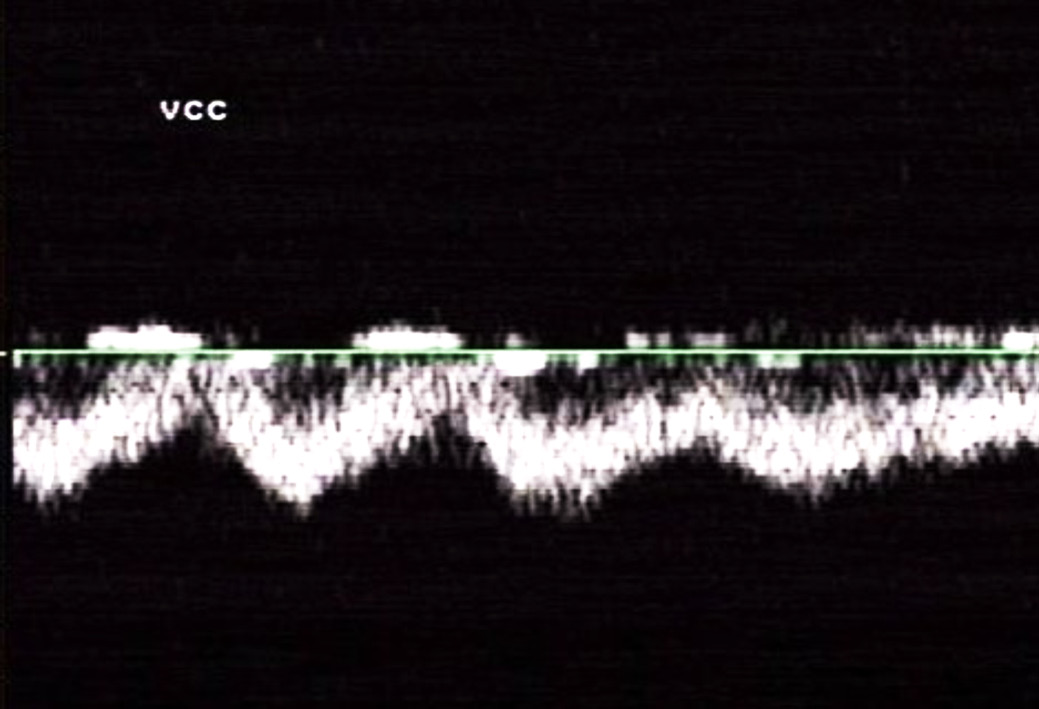 Avaliação morfométrica e hemodinâmica comparativa dos vasos envolvidos no shunt portossistêmico congênito em cães 943 A avaliação da onda espectral do fluxo sangüíneo da veia cava caudal foi