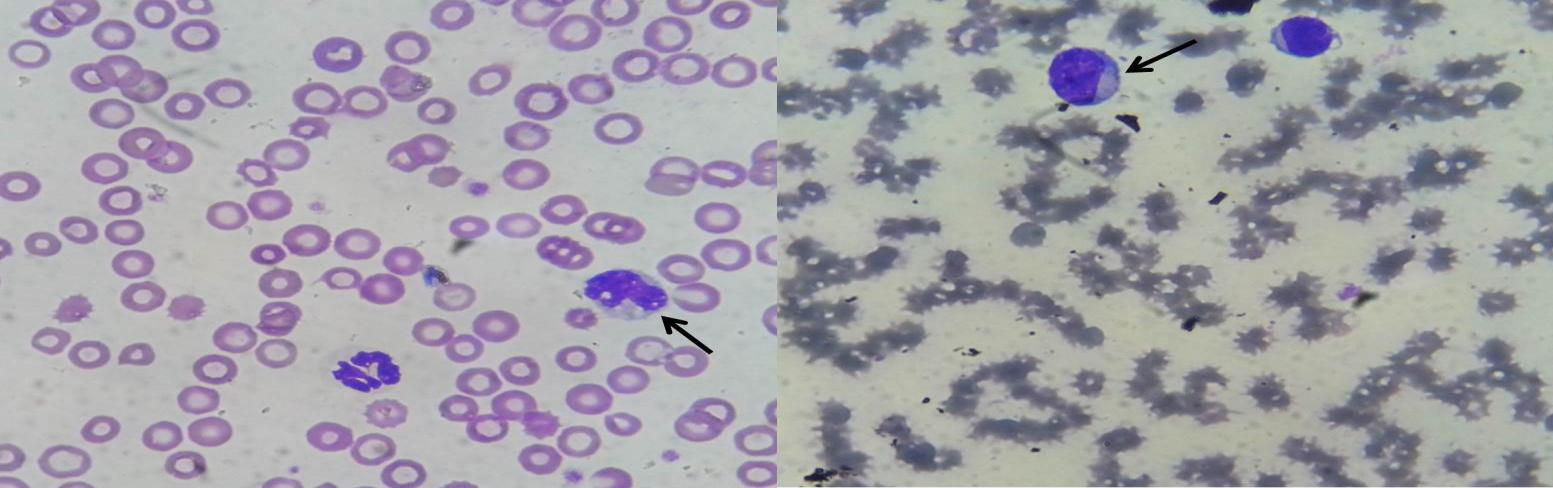 A B Figura 3: A-Esfregaço sanguíneo mostrando a presença de monócito vacuolizado em amostra de sangue do primeiro animal (seta).