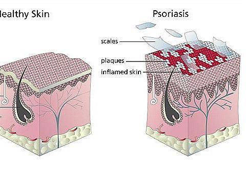 2 Psoríase 1,2,3 Pele saudável Psoríase Psoríase é uma doença inflamatória da pele.
