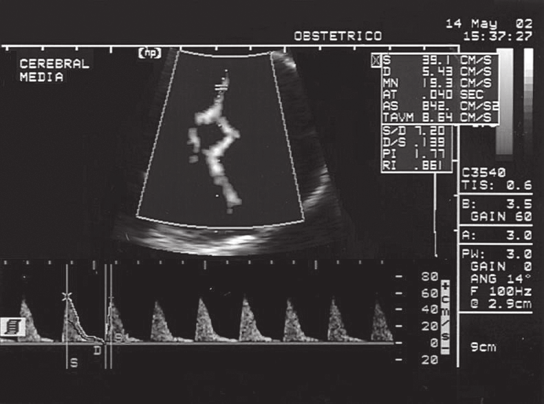 Assim sendo, o objetivo deste trabalho é determinar os valores normais do tempo de aceleração da artéria cerebral média fetal entre a 22 a e 38 a semanas de gestação e sua relação com a freqüência