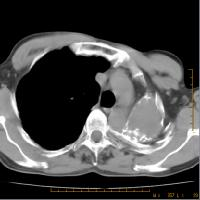 Paquipleurite tuberculosa com derrame enquistado Pneumotórax Ar livre no saco pleural Espontâneo ruptura de bolhas enfisematosas (vértices) Traumático fractura costal Iatrogénico punção do saco