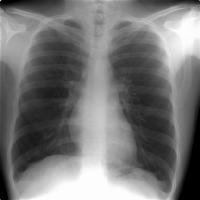 Variantes do normal O coração Avaliação da silhueta cardíaca Determinação das dimensões Índice cardio-torácico Cardiomegália global Aumento de cavidades isoladas