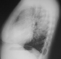 Sombra cardíaca em radiografias do tórax b a índice