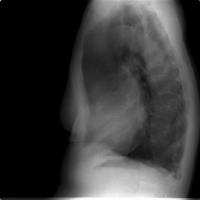 TAC e estadiamento tumoral Caracterização da massa pulmonar morfologia, estrutura, etc.