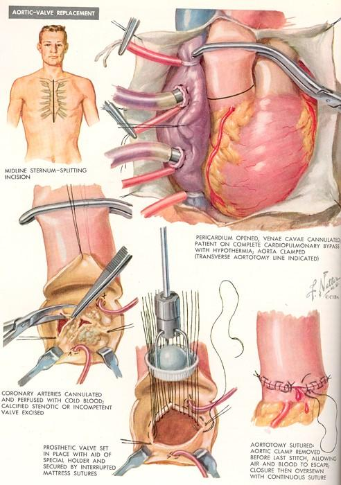 Cirurgia é o Tratamento Gold Standard Anestesia geral Esternostomia