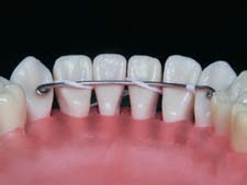 Alternativas para a fixação da contenção fixa ântero-inferior durante a colagem A b c d e f g h i Figura 2 - Passo-a-passo da fixação da contenção com fio dental.