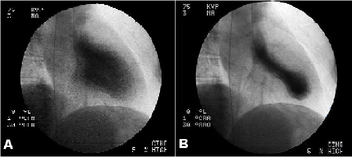 Machado EG et al Figura 3 Ventriculografia esquerda: A-Diástole ventricular B-Sístole ventricular evidenciando balonamento apical do VE, semelhante ao Takotsubo.