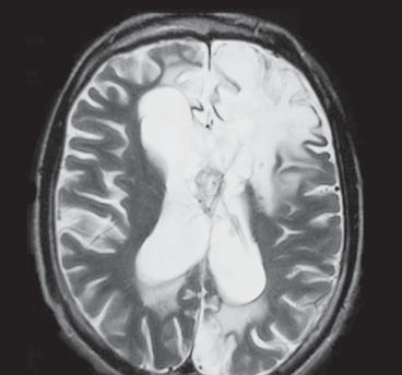 astro F et al. / Lesões expansivas intraventriculares à RM parte 2 Figura 2. Paciente do sexo masculino, 31 anos.