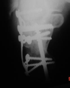 radiografia. Nossa lembrança de uma radiografia frequentemente é mais intensa do que a informação do paciente quanto ao lado comprometido.