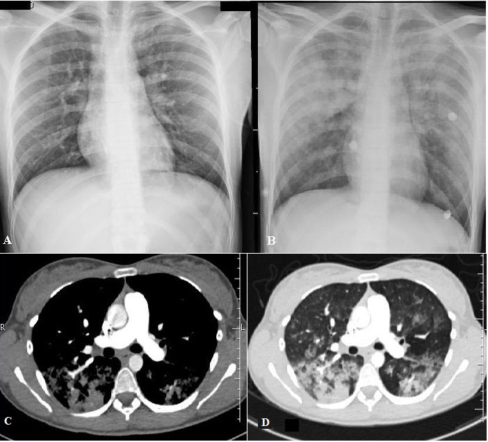 Embolia Gordurosa: Figura 2 A) Radiografia de tórax na admissão, normal. B) Radiografia após 48 horas de evolução com presença de infiltrado alveolar difuso.