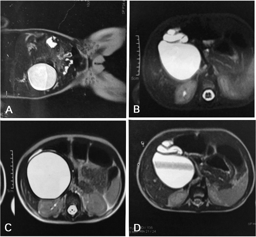 A hiperbilirrubinemia com predomínio da fração indireta (não conjugada) ocorre pelos seguintes mecanismos: aumento da carga de bilirrubina a ser metabolizada pelo fígado (hemólise intravascular,