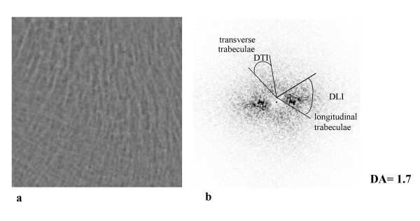 99 densitometria mineral óssea não responde às questões relacionadas a arquitetura vertebral [87]. Em 2005, Chappard et al.