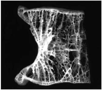 27 quantidade de osso formado pelos osteoblastos no local de modelação é igual à quantidade de osso previamente reabsorvido; c) perda irreversível de todos os elementos das trabéculas: ocorre quando