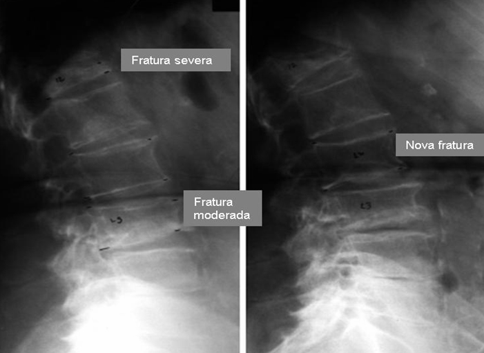 84 Numerosas abordagens têm sido usadas para definir fratura vertebral a partir de radiografias da coluna.