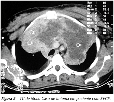 Terrível Linfoma - é uma neoplasia hematológica que acomete linfonodos.